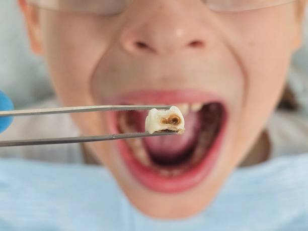 Best Emergency Tooth Extraction in Ucon, ID